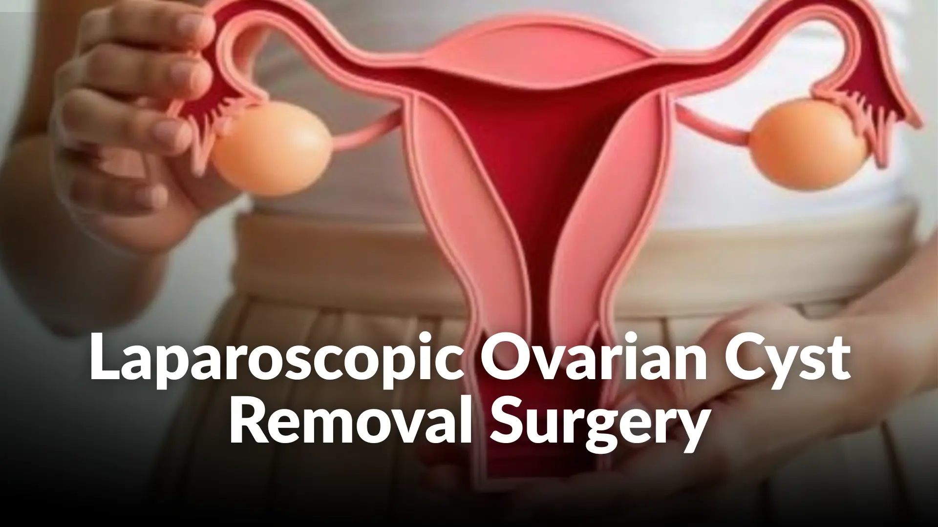 Laparoscopic Ovarian Cyst